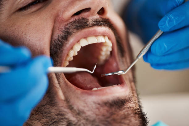 Dental Bonding in Addison, TX